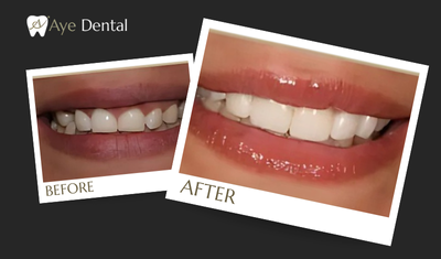 VENEERS