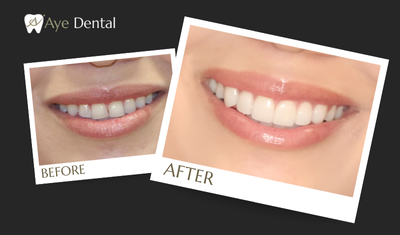 VENEERS